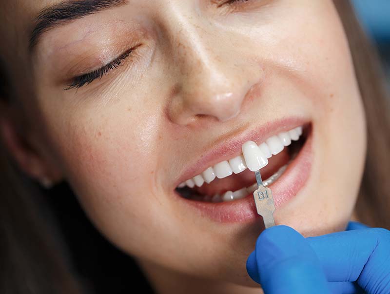 carillas-esteticas-dientes-en-clinica-dental-chavez